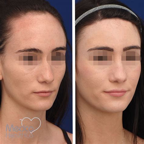 Forehead Reduction Surgery | Medco Healthco | Stay Safe and Healthy