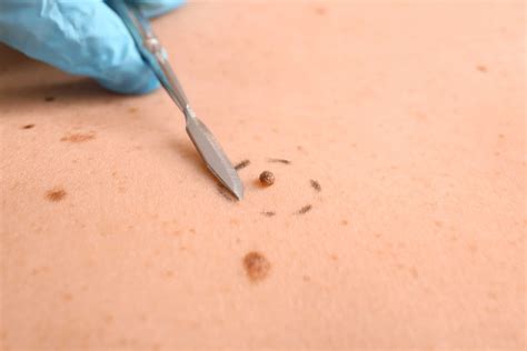 Skin Tag: What is a skin tag and how do I get rid of it?