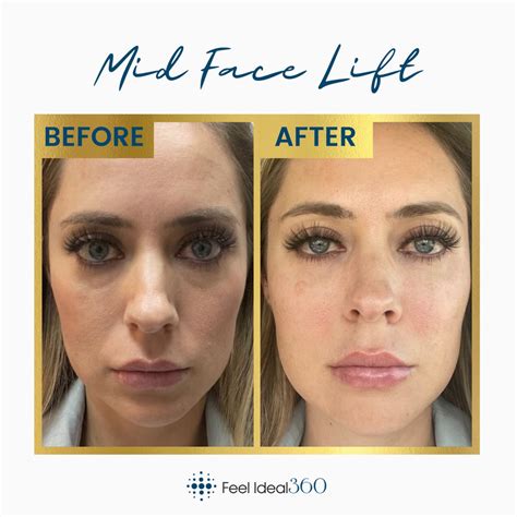 Mid Face Lift Before and After Southlake Texas - Feel Ideal 360 Med Spa - Southlake, TX