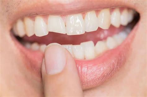 Cracked Tooth: Causes, Symptoms, and Treatment Options - Magnetic Goals