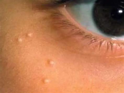 Sebaceous cysts: treatment, symptoms - Health 2023