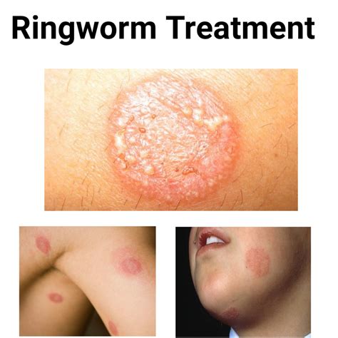 Ringworm Home Treatment: Discover The Secret To Remove Ringworm Naturally Ebook By James Collins ...