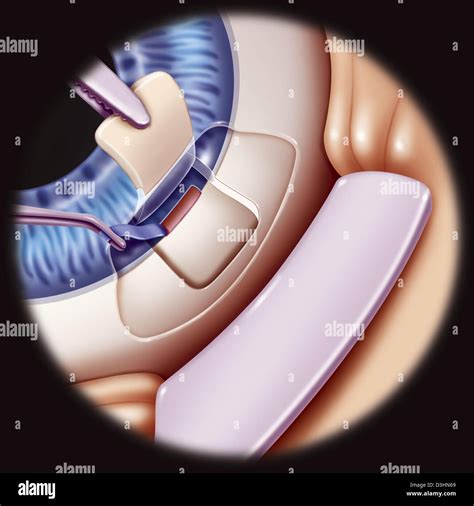 GLAUCOMA SURGERY, DRAWING Stock Photo - Alamy