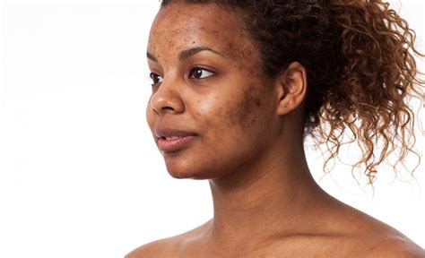 Deep Acne Scars: Prevention Tips and Treatment Guide | Alinea Med Spa