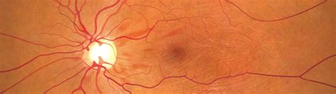 A Treatment for an ‘Untreatable’ Blinding Condition - Rendia