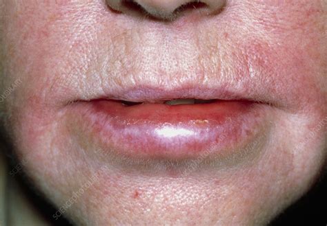 What Allergy Causes Swollen Lips - Infoupdate.org