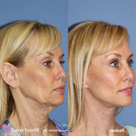 Lower Facelift: What to Expect, Results, Cost | RealSelf | Facelift, Skin removal surgery, Mini ...