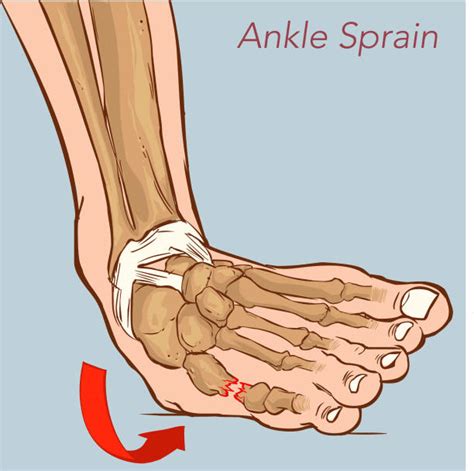 Ankle Sprain Illustrations, Royalty-Free Vector Graphics & Clip Art ...