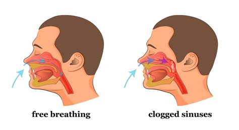 Can Air Con Give You A Blocked Nose at Tracy Olson blog