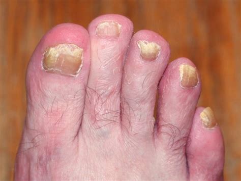 What Causes Fungal Nail Infection In Toes at Harold Curcio blog