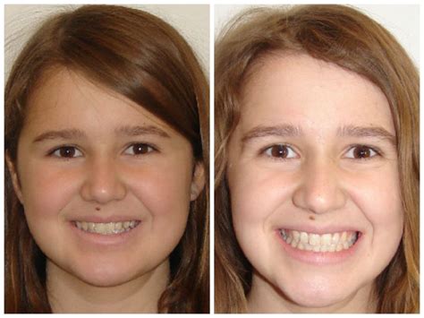 Pin by Dr. Paula Baby and Dr. Jaime R on Before and After Braces! | After braces, Braces