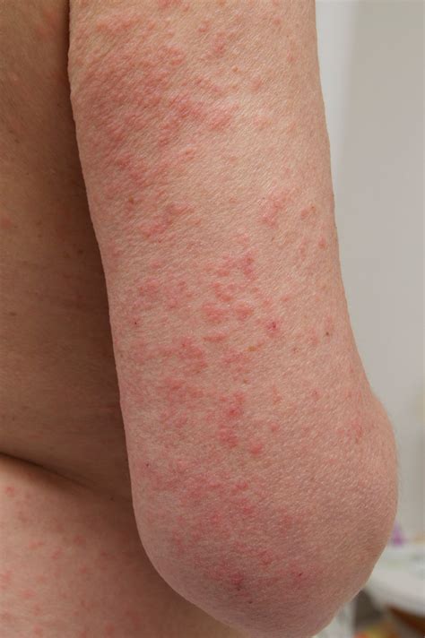 What Does a Sun Poisoning Rash Look Like? - Sun Poisoning Symptoms