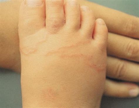 Cutaneous Larva Migrans - Skin Disorders - Merck Manuals Consumer Version