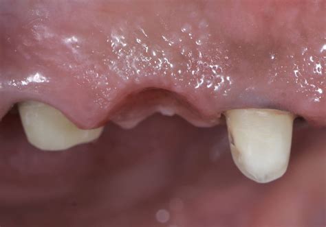 Dental Esthetics: Ovate pontic for the correct emergence profile.. A clinical case