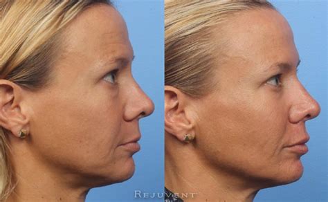 Liquid Facelift Photos Beautiful Results Rejuvent Scottsdale