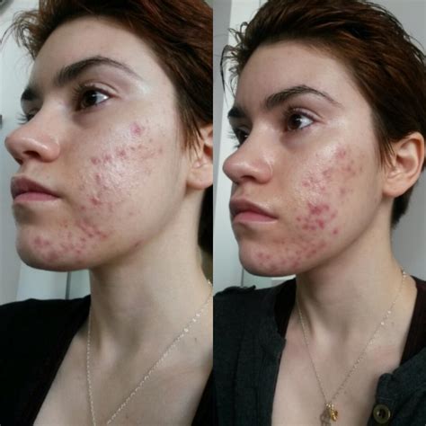 [B&A] End of week 2 on Adapalene(Differin) 0.1% gel. I've applied it 4 times. Safe to say I'm ...