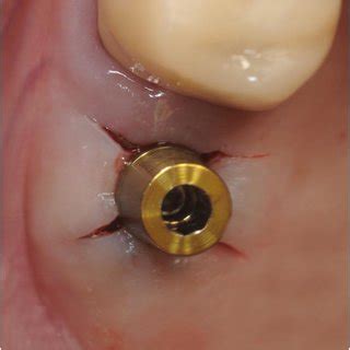 Periapical X-ray taken with the paralleling technique of the clinical ...