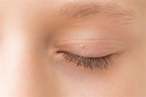 Lumps & Bumps On Eyelid | Olelo