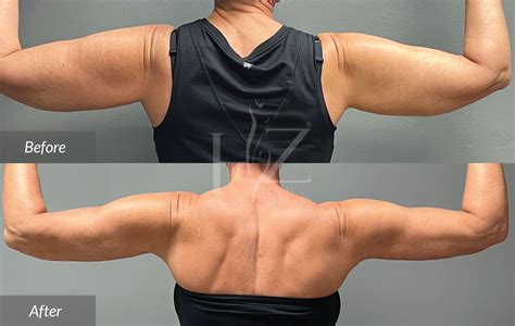 Arm Lift Before & After — HZ Plastic Surgery