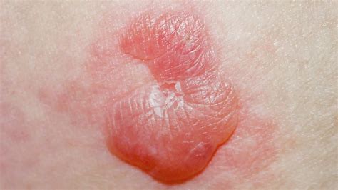 Skin Lesions: Pictures, Causes, Diagnosis, Treatment & More