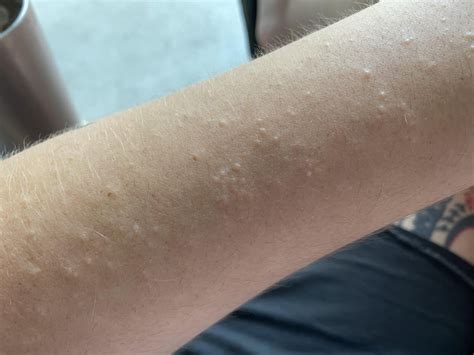 Clusters of small bumps on my arm : r/DermatologyQuestions