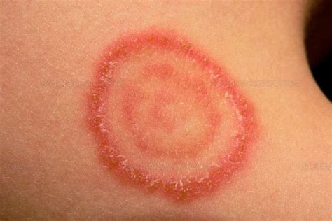 Ringworm: Causes, symptoms and treatment