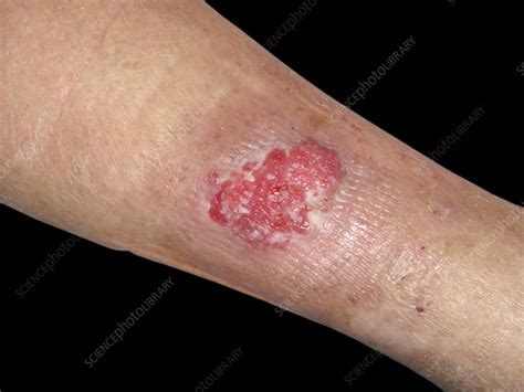 Squamous cell carcinoma on a woman's leg - Stock Image - C058/3150 ...