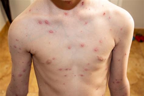 A North Carolina School Is Having a Chicken Pox Outbreak - Business Insider