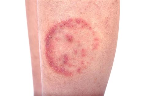 Ringworm | Cause, Symptoms, & Treatment | Britannica