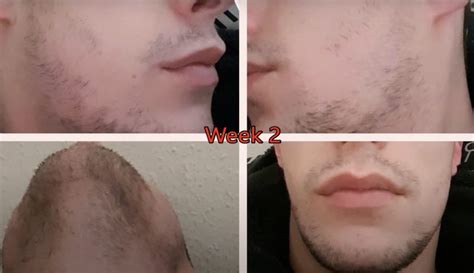 Minoxidil Beard Growth: Real Before And After Photos, 59% OFF