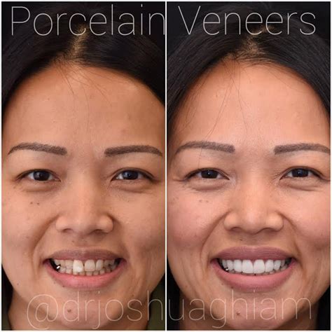 Good Veneers Vs Bad Veneers