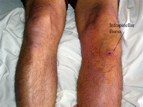 Prepatellar bursitis - wikidoc