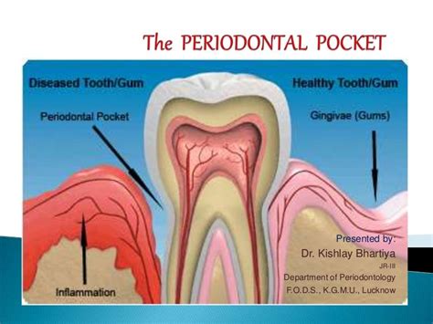 Periodontal Pocket