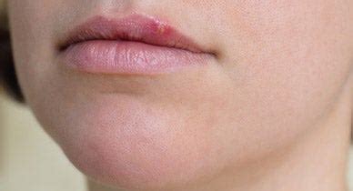 Upper Lip Swelling Food Allergy | Sitelip.org