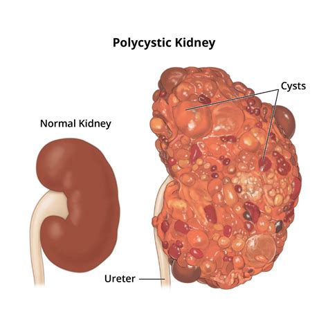 Polycystic Kidney Disease (PKD) - NIDDK