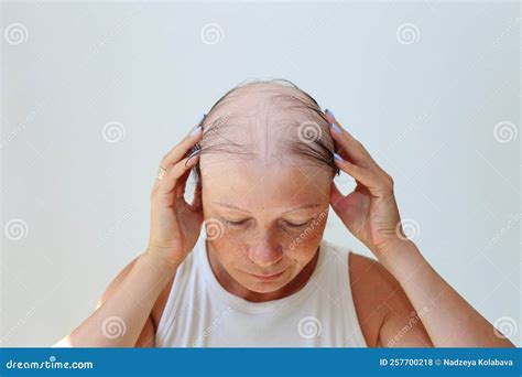 Hair Loss in the Form of Alopecia Areata. Stock Photo - Image of face, autoimmune: 257700218