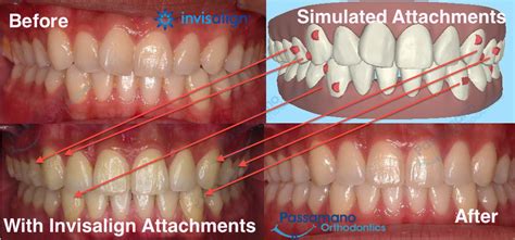 What Are Invisalign Attachments? - Passamano Orthodontics