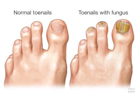 Top more than 118 fungal nail infection in child - songngunhatanh.edu.vn