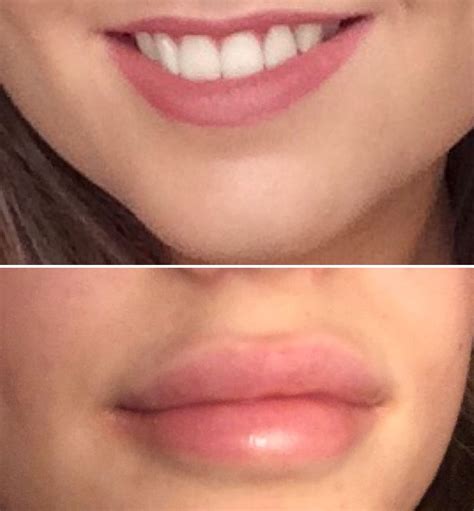 diy lip filler injections - Maribeth Ashley