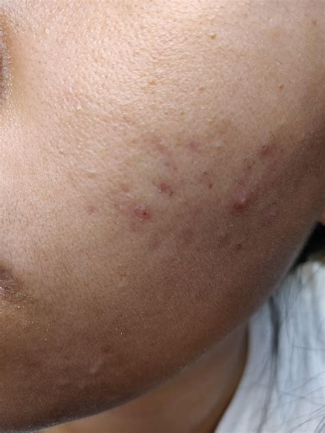 [skin concerns] Acne scarring is not inproving (6 months) : r/SkincareAddiction