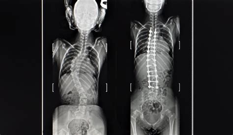 Minimally-Invasive Scoliosis Surgery | New Jersey | Comprehensive Spine Care