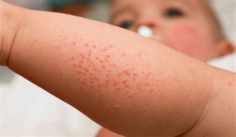 Identifying Spots On Your Toddler | Vujevich Dermatology