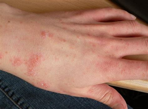 👉 Scabies Rash - Pictures, Symptoms, Treatment, Causes (February 2022)