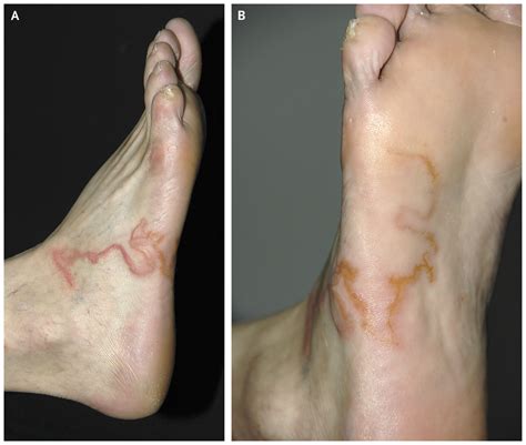 Creeping Eruption — Cutaneous Larva Migrans | NEJM