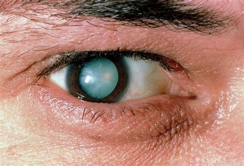 Male Patient's Eye With Mature Cataract Photograph by Sue Ford/science ...