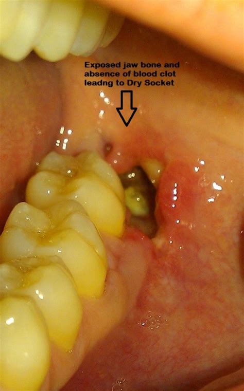 Dry Socket | Smile Delhi - The Dental Clinic