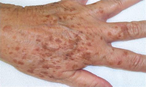 Manchas de la edad (queratosis seborreica, Solar Léntigo lentigos ...