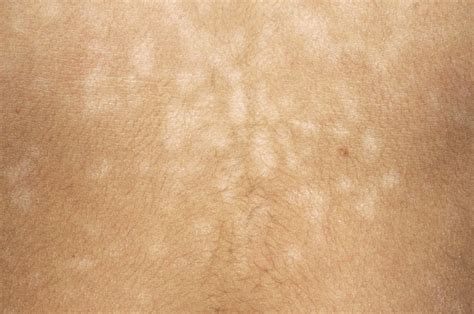 The Health Hub: Pityriasis versicolor