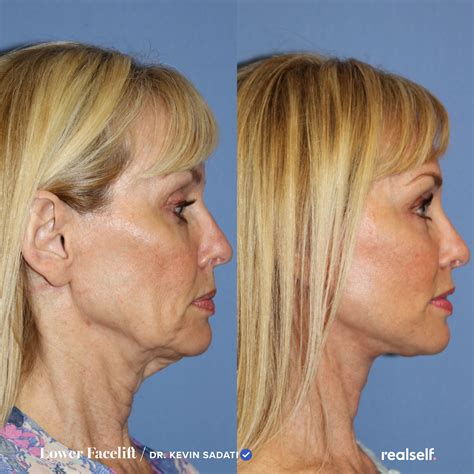 Facelift recovery – Artofit