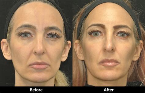 Liquid Facelift before and after